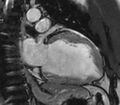 Cardiac sarcoidosis (Radiopaedia 39811-42243 B 7).jpg
