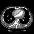 Cardiac tamponade (Radiopaedia 78607-91368 Axial C+ CTPA 59).jpg