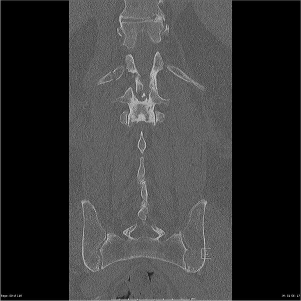File:Cardiac trauma (Radiopaedia 32874-33858 Coronal bone window 80).jpg