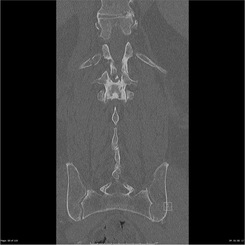 Cardiac trauma (Radiopaedia 32874-33858 Coronal bone window 80).jpg