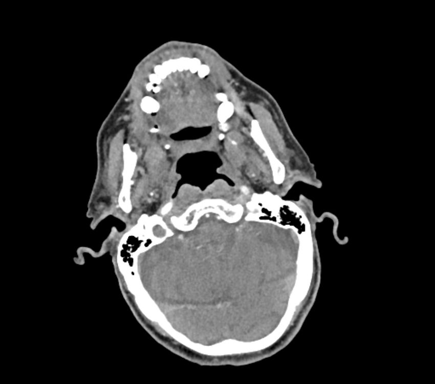 Carotid artery pseudoaneurysm (Radiopaedia 84030-99259 C 14).jpg