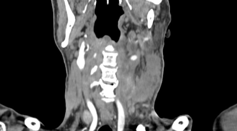 File:Carotid artery pseudoaneurysm (Radiopaedia 84030-99259 D 48).jpg