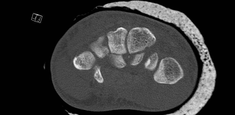 File:Carpal fractures (smart watch impaction) (Radiopaedia 55844-62430 Axial bone window 41).jpg