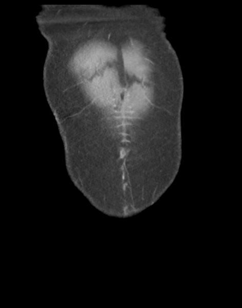File:Cecum hernia through the foramen of Winslow (Radiopaedia 46634-51112 B 5).png