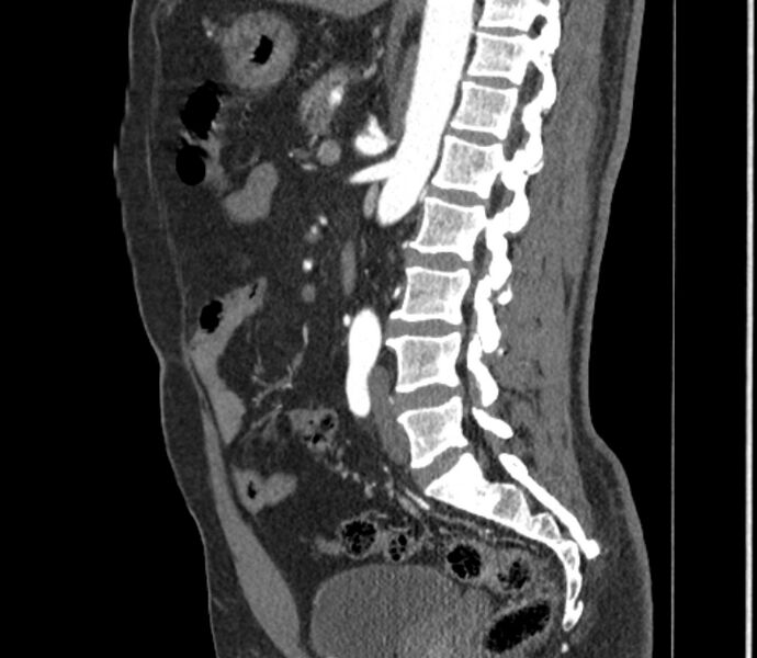 File:Celiac artery dissection (Radiopaedia 52194-58080 B 67).jpg
