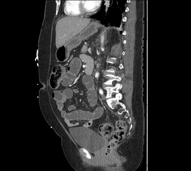File:Celiac artery severe stenosis and dissection (Radiopaedia 44128-47842 A 16).jpg