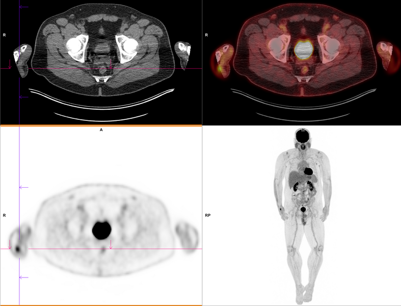 File:Cell phone usage artifact on PET-CT (Radiopaedia 72470-83000 A 1).PNG