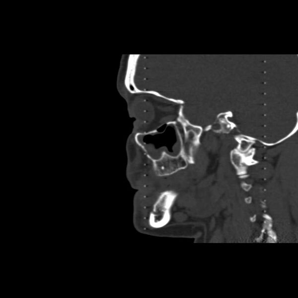 File:Cemento-ossifying fibroma (Radiopaedia 21243-21149 Sagittal bone window 1).jpg