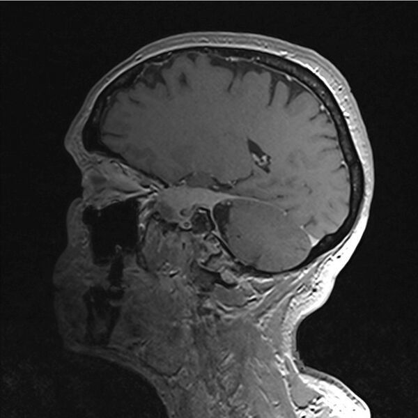 File:Central base of skull meningioma (Radiopaedia 53531-59549 Sagittal T1 C+ 46).jpg