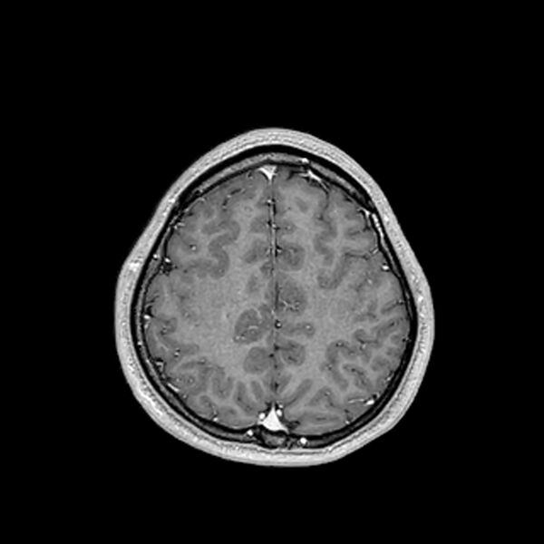File:Central neurocytoma (Radiopaedia 79320-92380 Axial T1 C+ 185).jpg