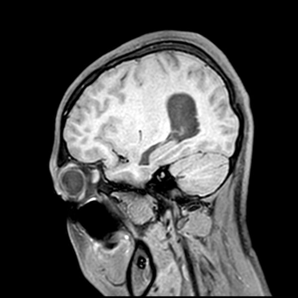 File:Central neurocytoma (Radiopaedia 79320-92380 Sagittal T1 187).jpg