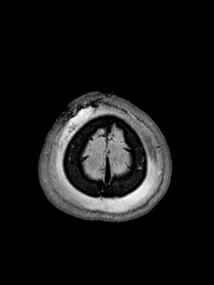 Central neurocytoma (Radiopaedia 79320-92381 Axial FLAIR 26).jpg