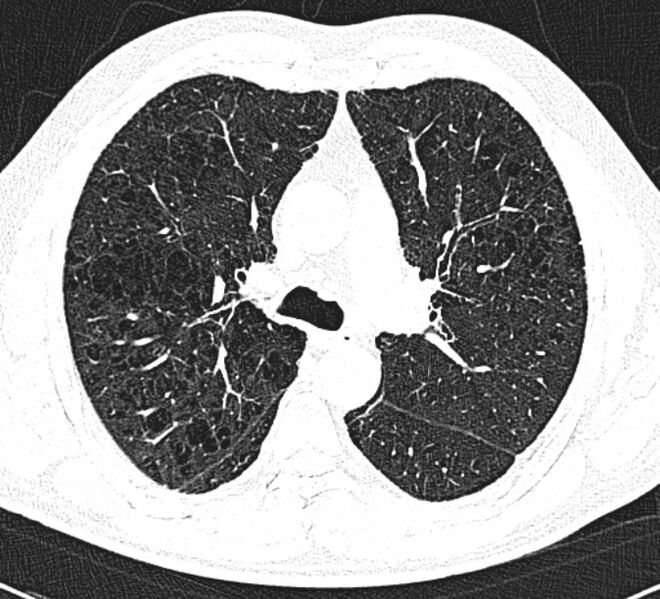 File:Centrilobular pulmonary emphysema (Radiopaedia 26808-26971 Axial lung window 16).jpg
