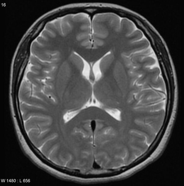 File:Cerebellar arteriovenous malformation (Radiopaedia 5220-6988 Axial T2 12).jpg