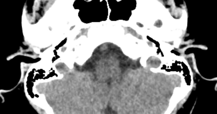 Cerebellopontine angle lipoma (Radiopaedia 57303-64242 B 20).jpg