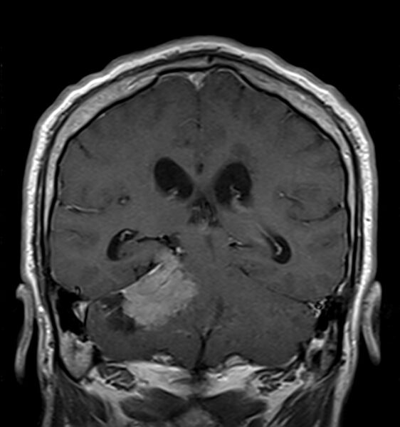 File:Cerebellopontine angle meningioma (Radiopaedia 24459-24764 Coronal T1 C+ 15).jpg
