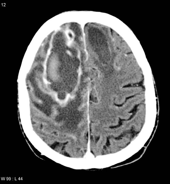 File:Cerebral abscesses secondary to contusions (Radiopaedia 5201-6967 Axial C+ delayed 7).jpg