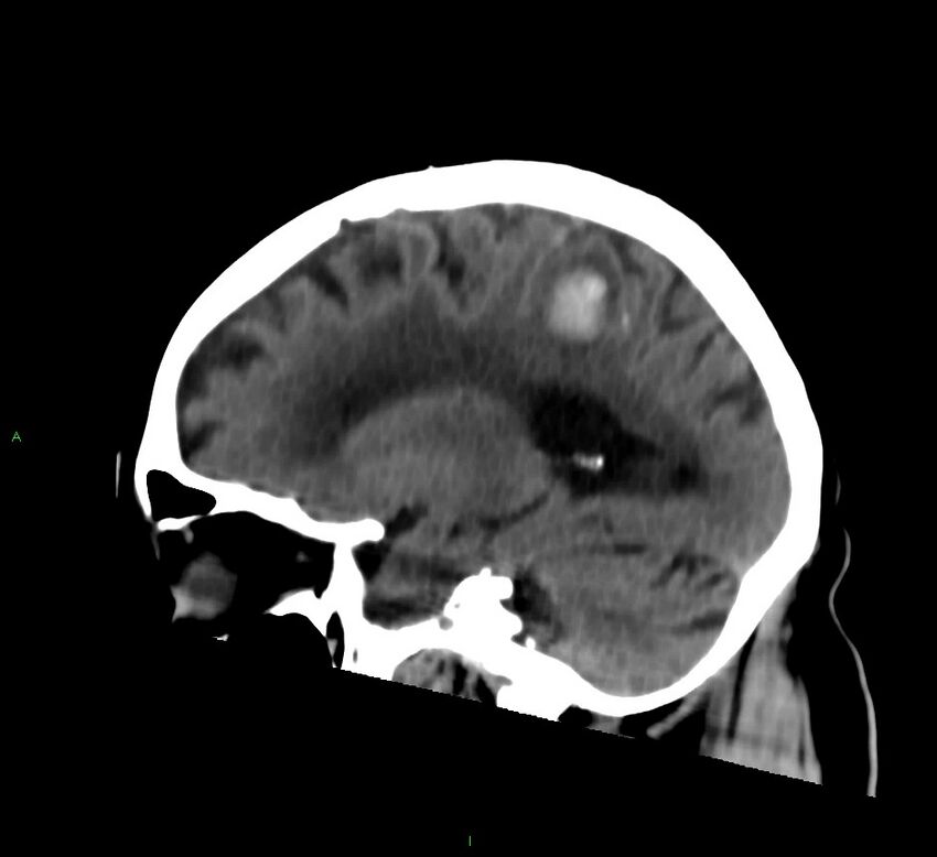 Cerebral amyloid angiopathy-associated lobar intracerebral hemorrhage (Radiopaedia 58376-65513 C 30).jpg