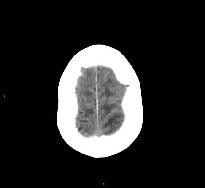 File:Cerebral amyloid angiopathy-associated lobar intracerebral hemorrhage (Radiopaedia 58530-65688 Axial non-contrast 7).jpg