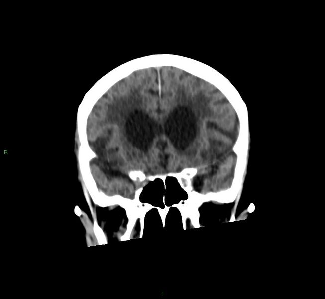 File:Cerebral amyloid angiopathy-associated lobar intracerebral hemorrhage (Radiopaedia 58530-65688 Coronal non-contrast 46).jpg