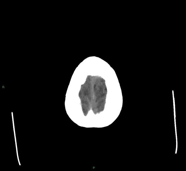 File:Cerebral amyloid angiopathy-associated lobar intracerebral hemorrhage (Radiopaedia 58560-65723 Axial non-contrast 6).jpg