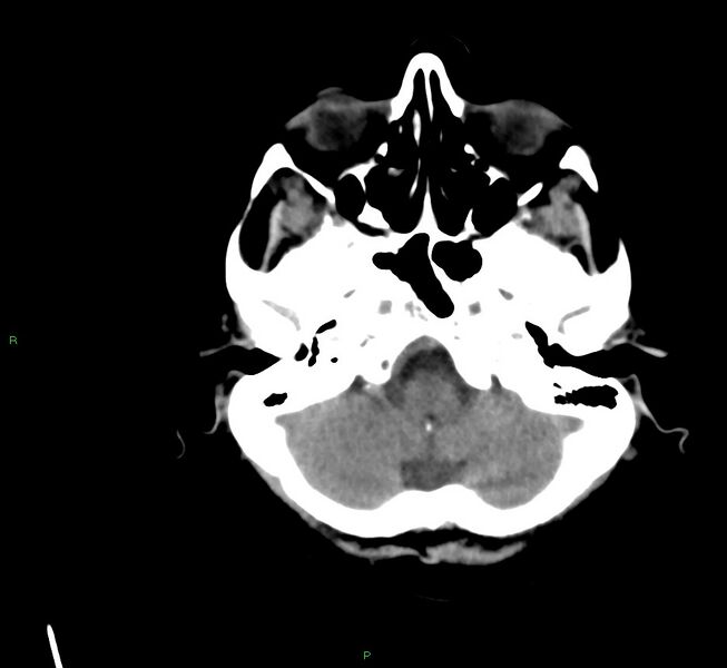 File:Cerebral amyloid angiopathy-associated lobar intracerebral hemorrhage (Radiopaedia 58561-65724 Axial non-contrast 39).jpg