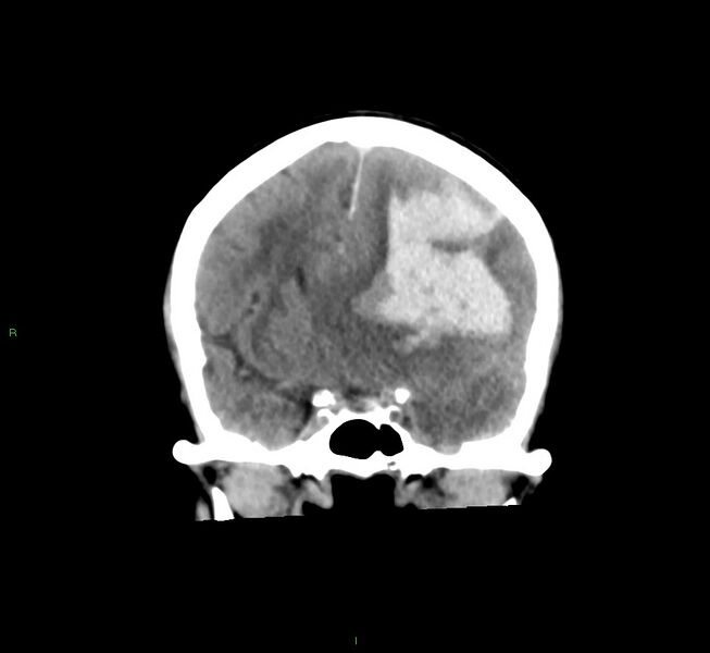 File:Cerebral amyloid angiopathy-associated lobar intracerebral hemorrhage (Radiopaedia 58561-65724 Coronal non-contrast 39).jpg