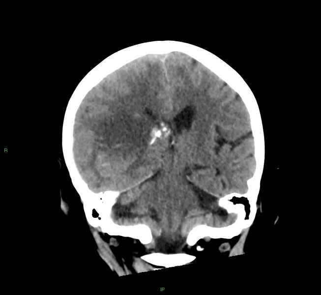 File:Cerebral amyloid angiopathy-associated lobar intracerebral hemorrhage (Radiopaedia 58563-65727 Coronal non-contrast 30).jpg