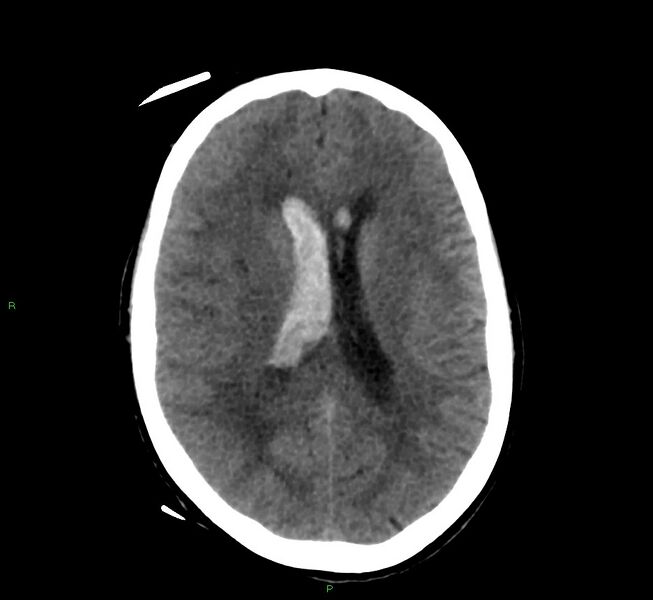 File:Cerebral amyloid angiopathy-associated lobar intracerebral hemorrhage (Radiopaedia 58566-65730 Axial non-contrast 23).jpg