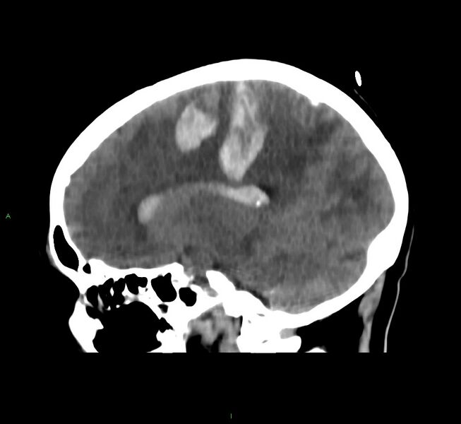 File:Cerebral amyloid angiopathy-associated lobar intracerebral hemorrhage (Radiopaedia 58566-65730 C 21).jpg