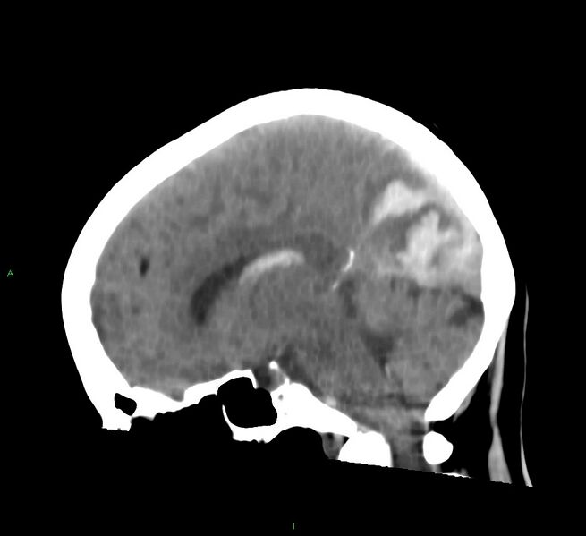 File:Cerebral amyloid angiopathy-associated lobar intracerebral hemorrhage (Radiopaedia 58754-65975 C 25).jpg