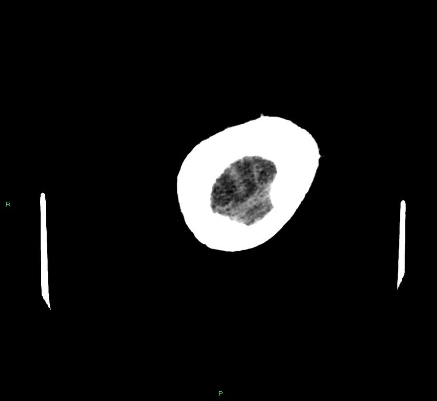 Cerebral amyloid angiopathy-associated lobar intracerebral hemorrhage (Radiopaedia 58757-65979 Axial non-contrast 139).jpg