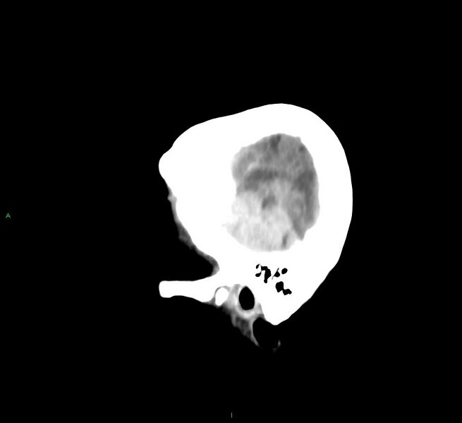File:Cerebral amyloid angiopathy-associated lobar intracerebral hemorrhage (Radiopaedia 58758-65980 C 7).jpg