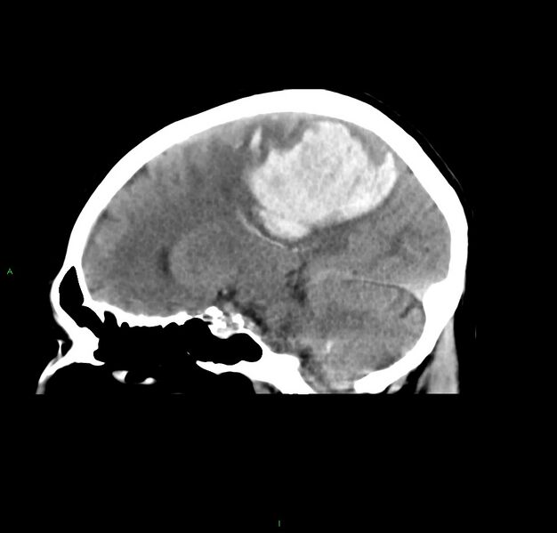 File:Cerebral amyloid angiopathy-associated lobar intracerebral hemorrhage (Radiopaedia 59356-66716 C 24).jpg