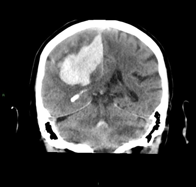 File:Cerebral amyloid angiopathy-associated lobar intracerebral hemorrhage (Radiopaedia 59356-66716 Coronal non-contrast 26).jpg