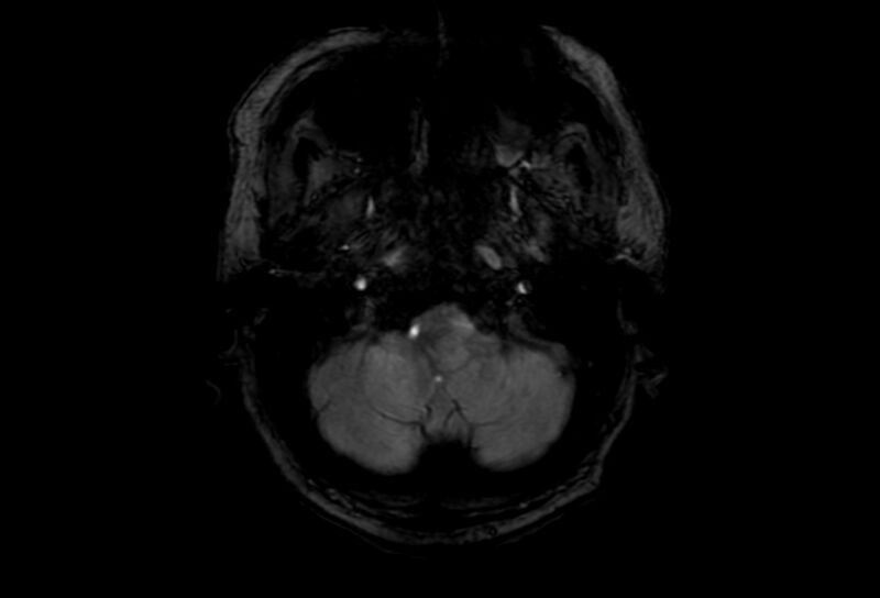 File:Cerebral amyloid angiopathy (Radiopaedia 86671-102792 Axial Gradient Echo 51).jpg