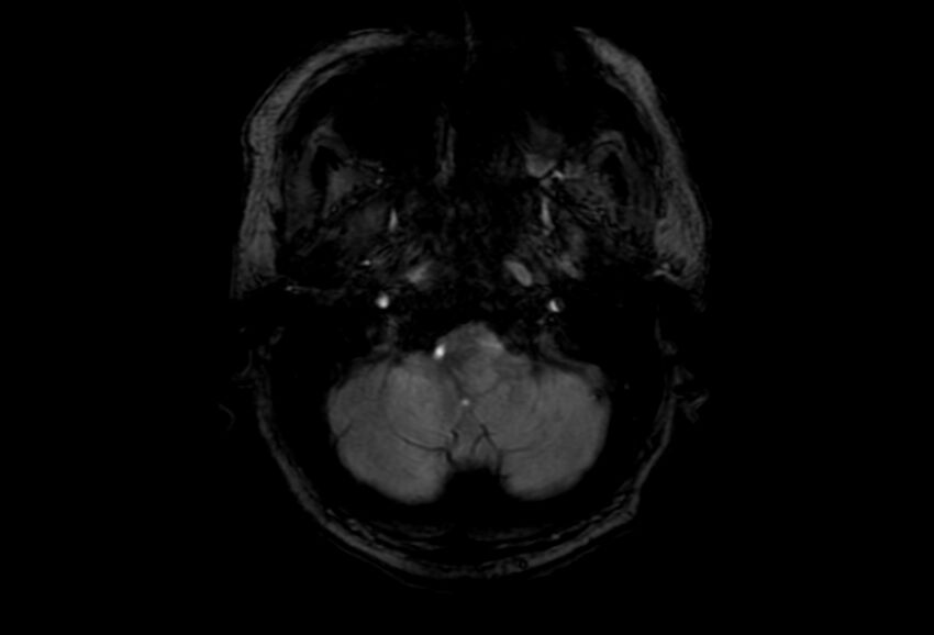Cerebral amyloid angiopathy (Radiopaedia 86671-102792 Axial Gradient Echo 51).jpg