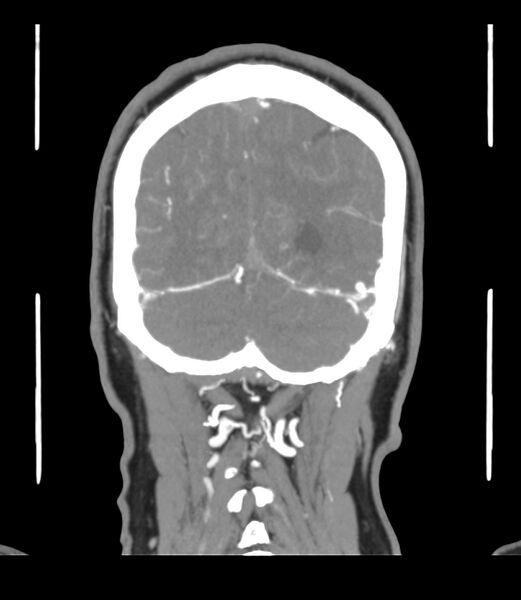 File:Cerebral dural venous sinus thrombosis (Radiopaedia 86514-102576 B 62).jpg