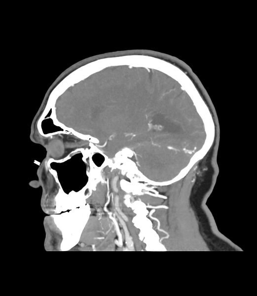 File:Cerebral dural venous sinus thrombosis (Radiopaedia 86514-102576 C 39).jpg