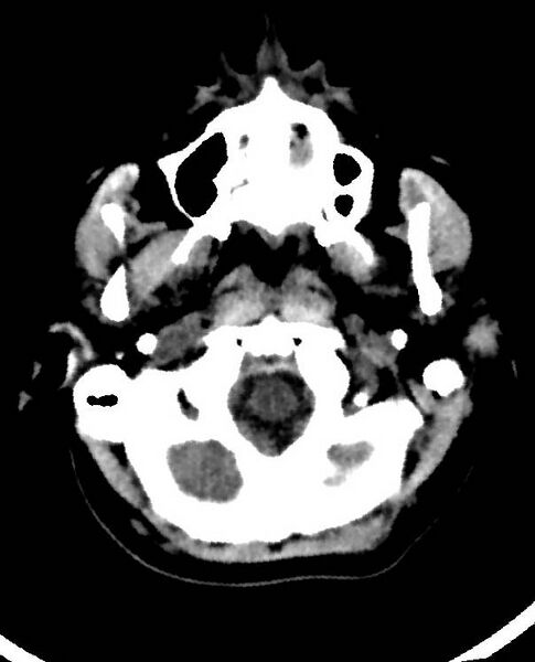 File:Cerebral edema due to severe hyponatremia (Radiopaedia 89826-106938 Axial non-contrast 12).jpg