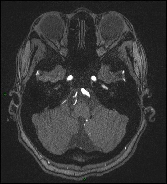 File:Cerebral fat embolism (Radiopaedia 35022-36525 Axial TOF 37).jpg