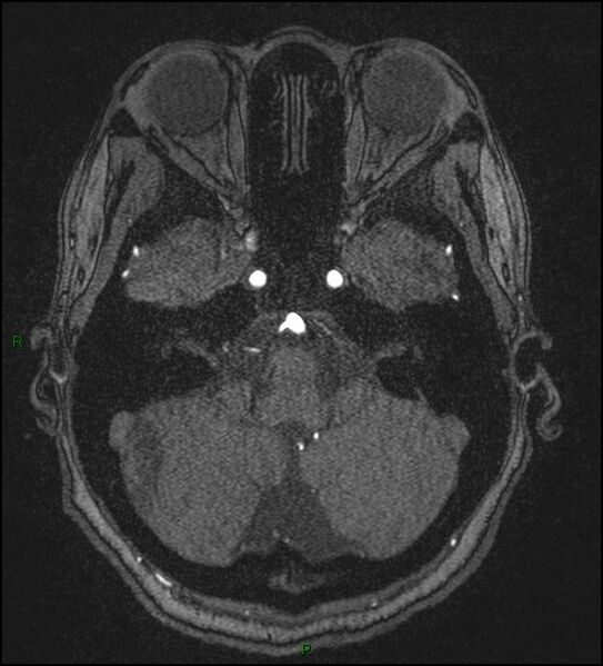 File:Cerebral fat embolism (Radiopaedia 35022-36525 Axial TOF 41).jpg