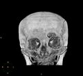 Cerebral hemorrhagic contusions (Radiopaedia 23145-23188 3D MIP 1).jpg