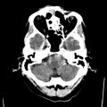 Cerebral hemorrhagic contusions (Radiopaedia 23145-23188 Axial non-contrast 6).jpg