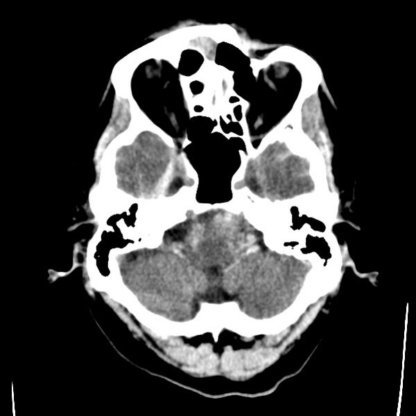 File:Cerebral hemorrhagic contusions (Radiopaedia 23145-23188 Axial non-contrast 6).jpg