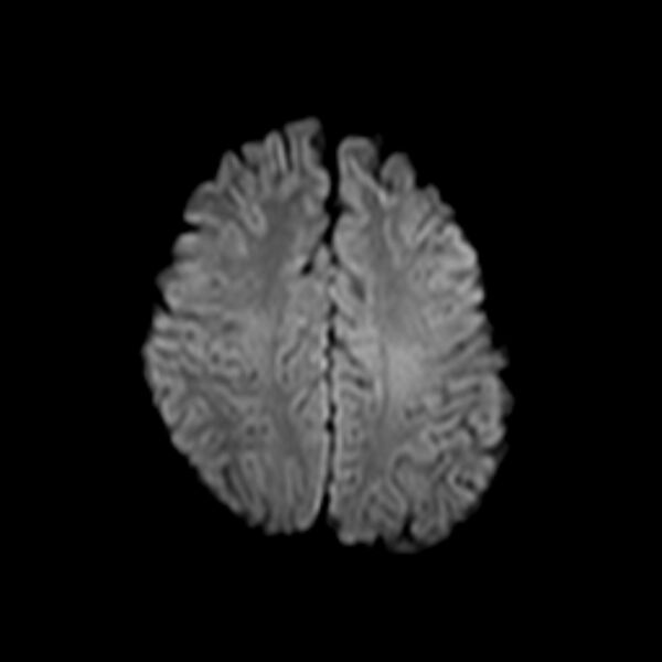 File:Cerebral tuberculoma (Radiopaedia 41152-43932 Axial DWI 18).jpg