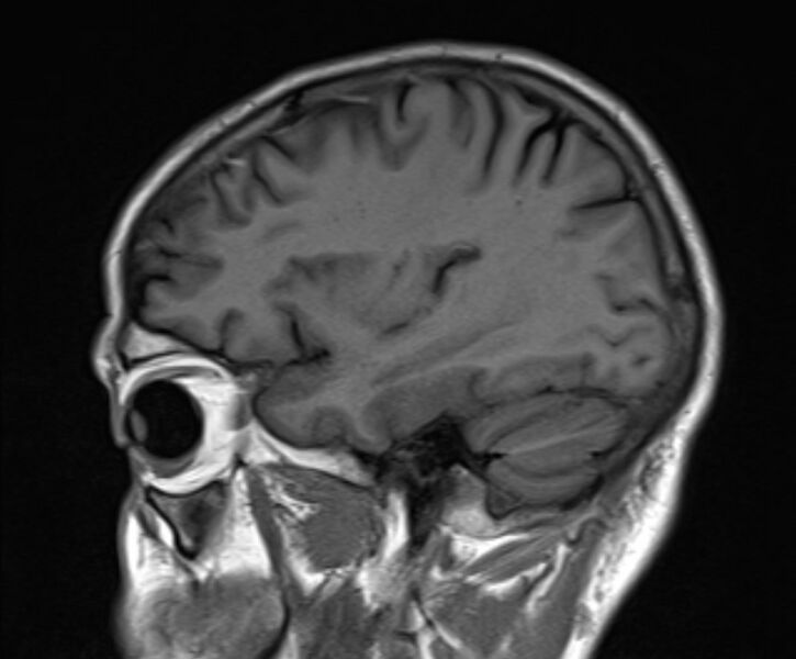 File:Cerebral venous thrombosis (Radiopaedia 71207-81504 Sagittal T1 19).jpg