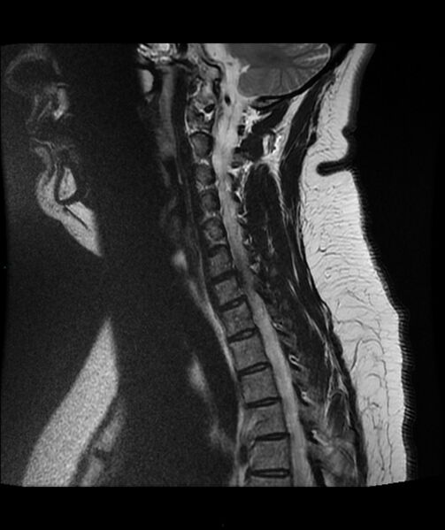 File:Cervical disc prolapse (Radiopaedia 80258-93598 Sagittal T2 5).jpg