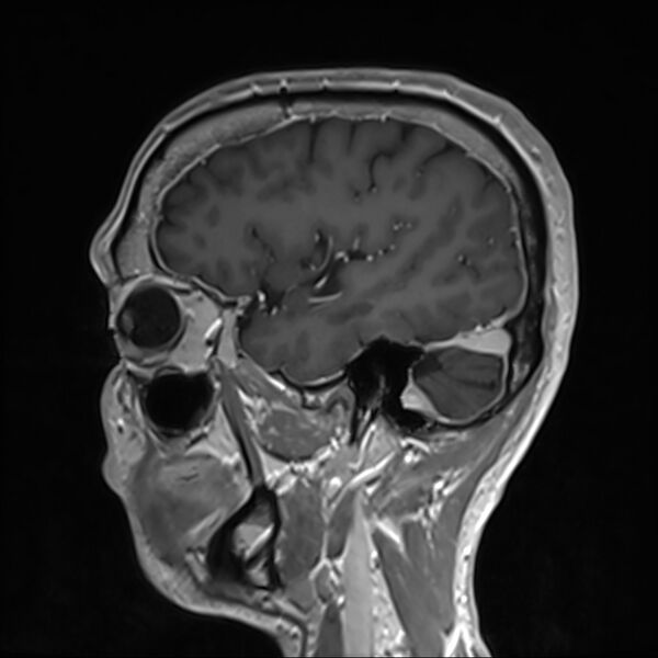 File:Cervical dural CSF leak on MRI and CT treated by blood patch (Radiopaedia 49748-54995 G 17).jpg