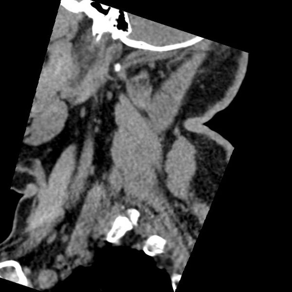 File:Cervical spinal neurofibroma in a patient with NF1 (Radiopaedia 58344-65464 C 5).jpg